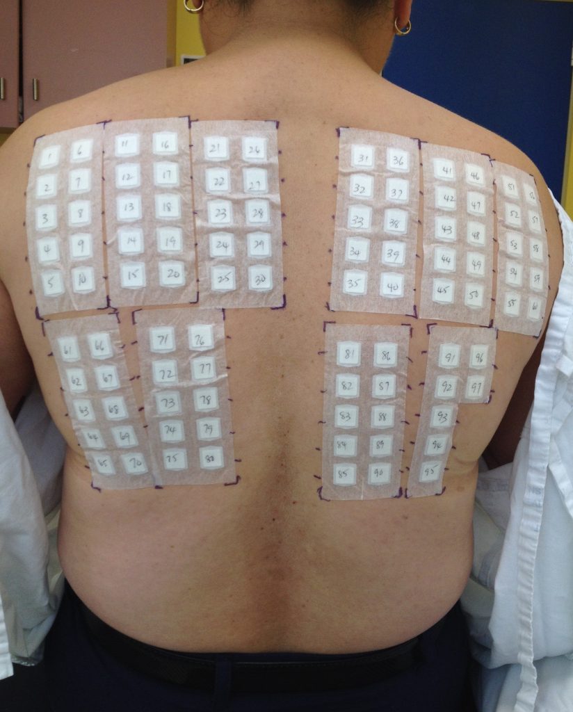 ACD A-Z of Skin - Allergy patch testing