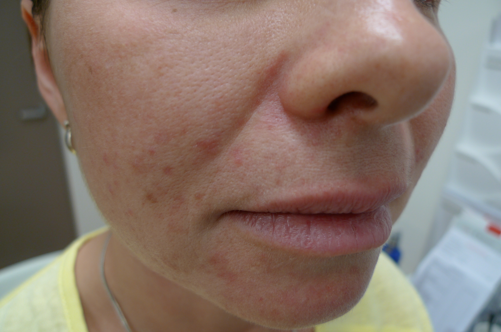 Perioral dermatitis Image reproduced with permission of Dr Davin Lim