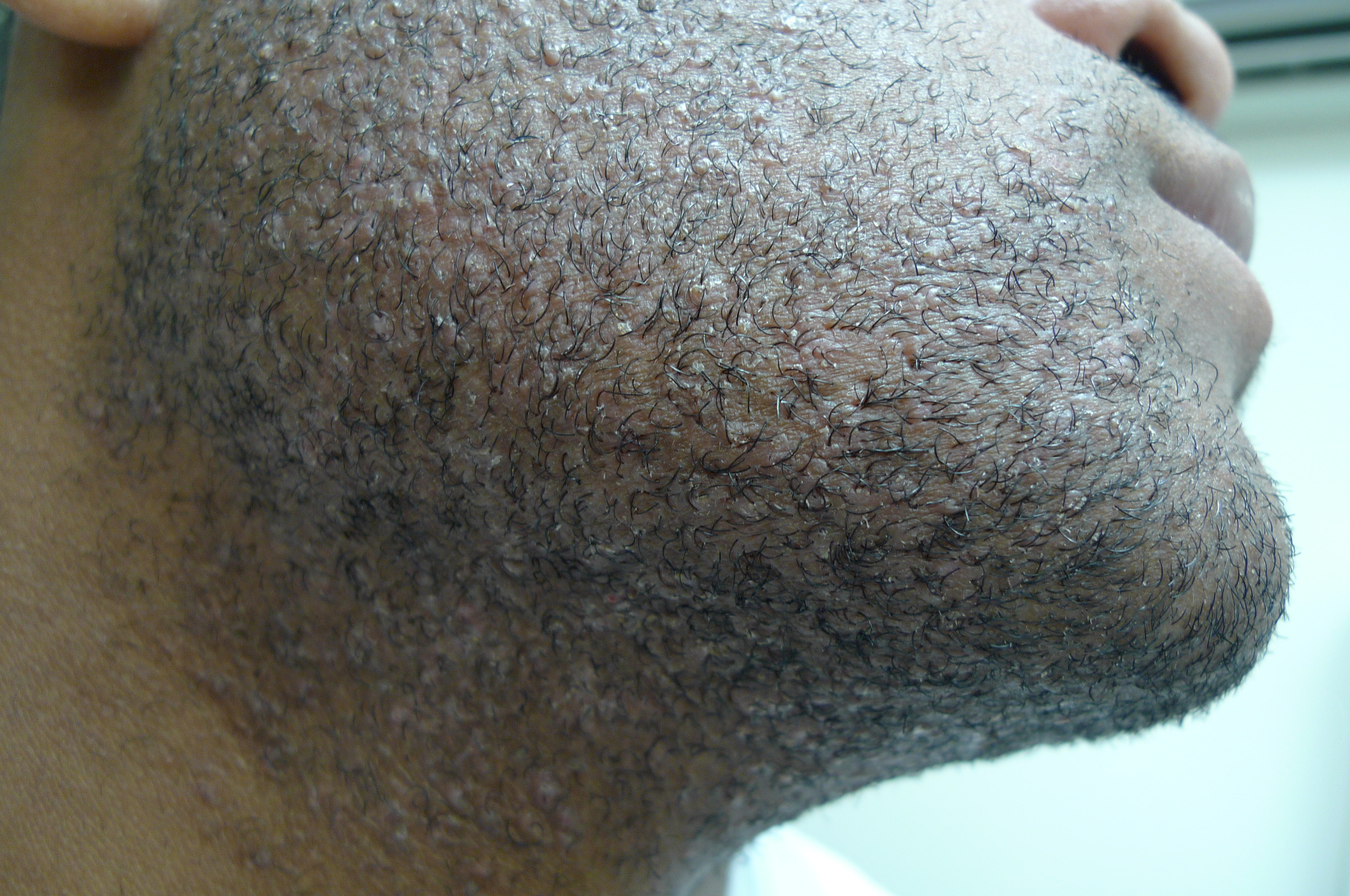 bump on base of shaft under skin