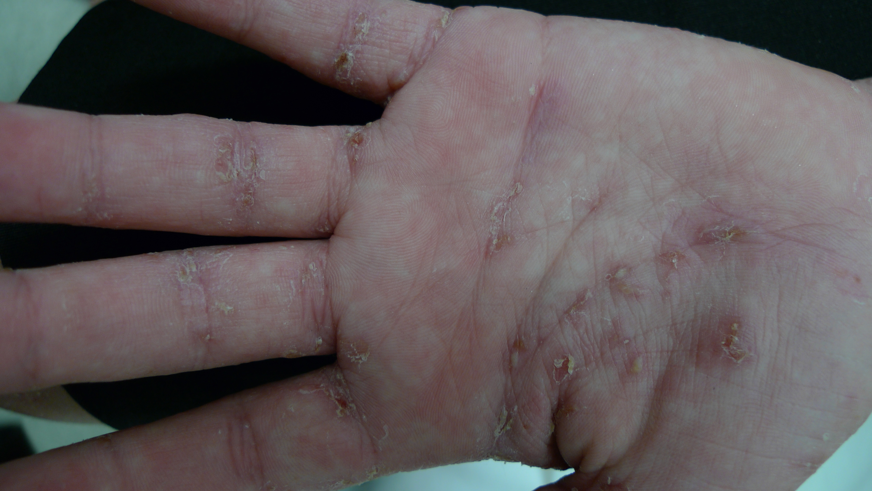 Scabies on the hand - image reproduced with permission of Dr Davin Lim