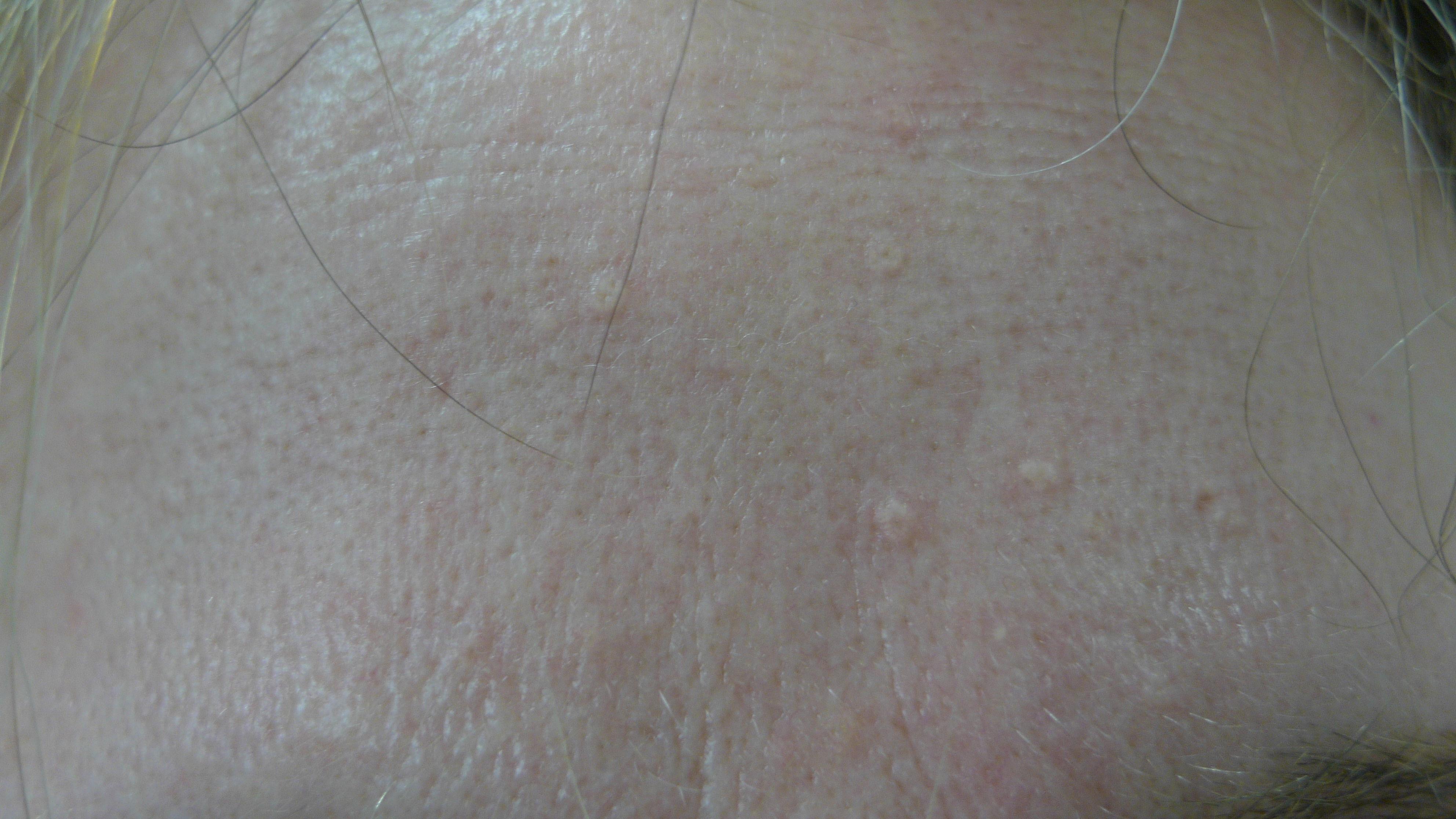 Sebaceous hyperplasia Images reproduced with permission of Dr Davin Lim