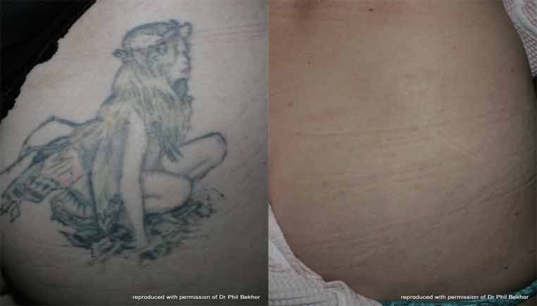 Tattoo removal methods revealed